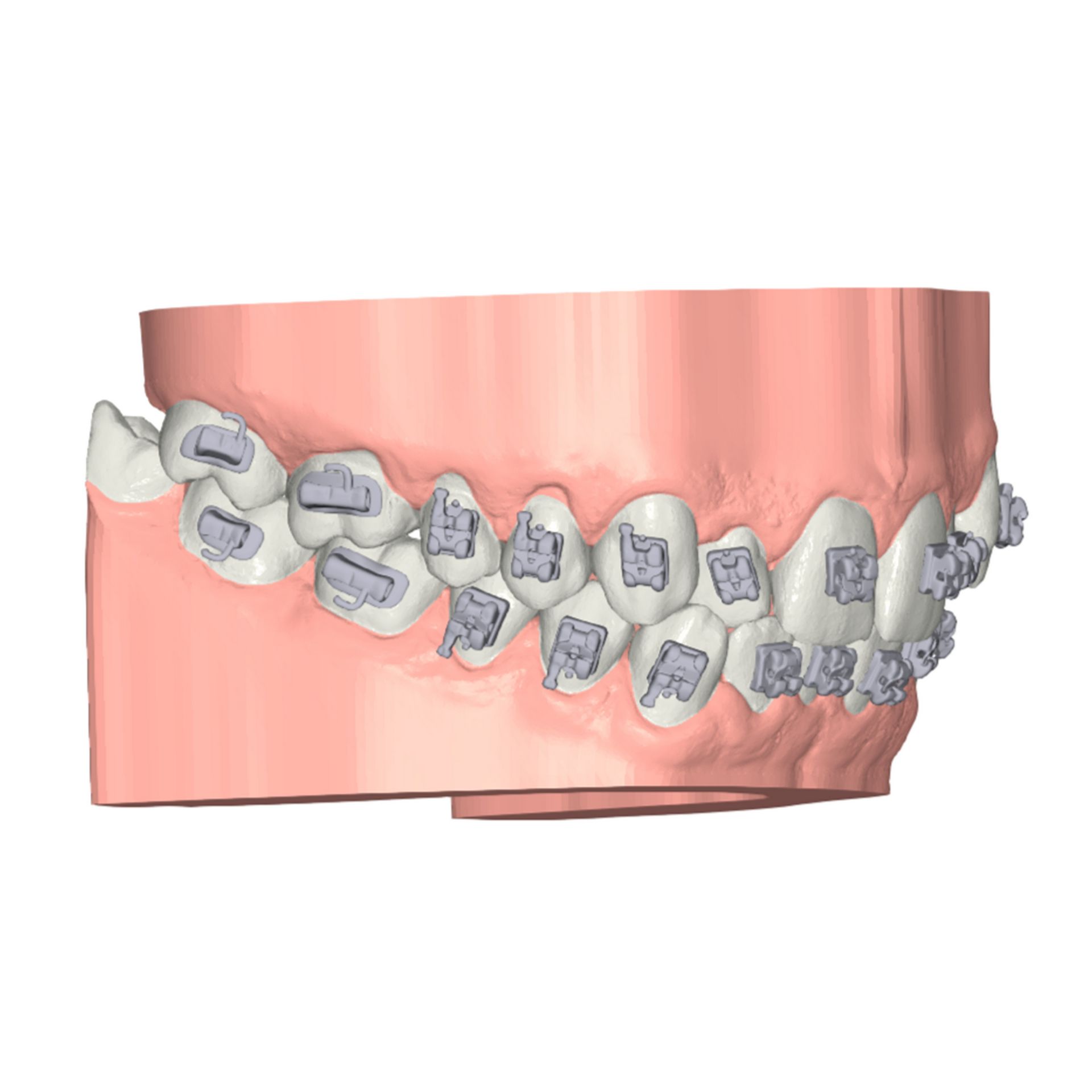 Bracket guides