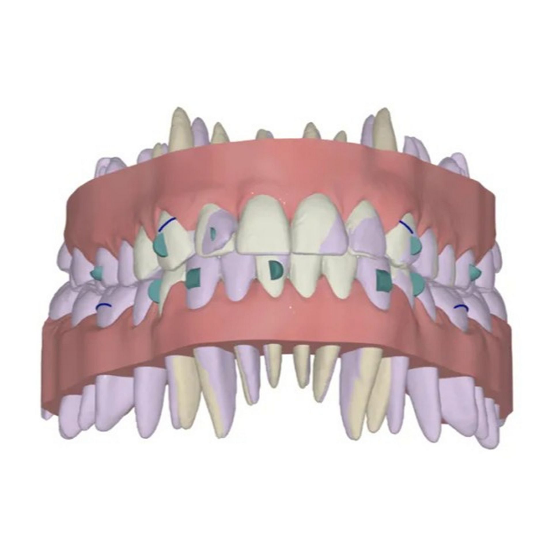 Invisible orthodontic planning