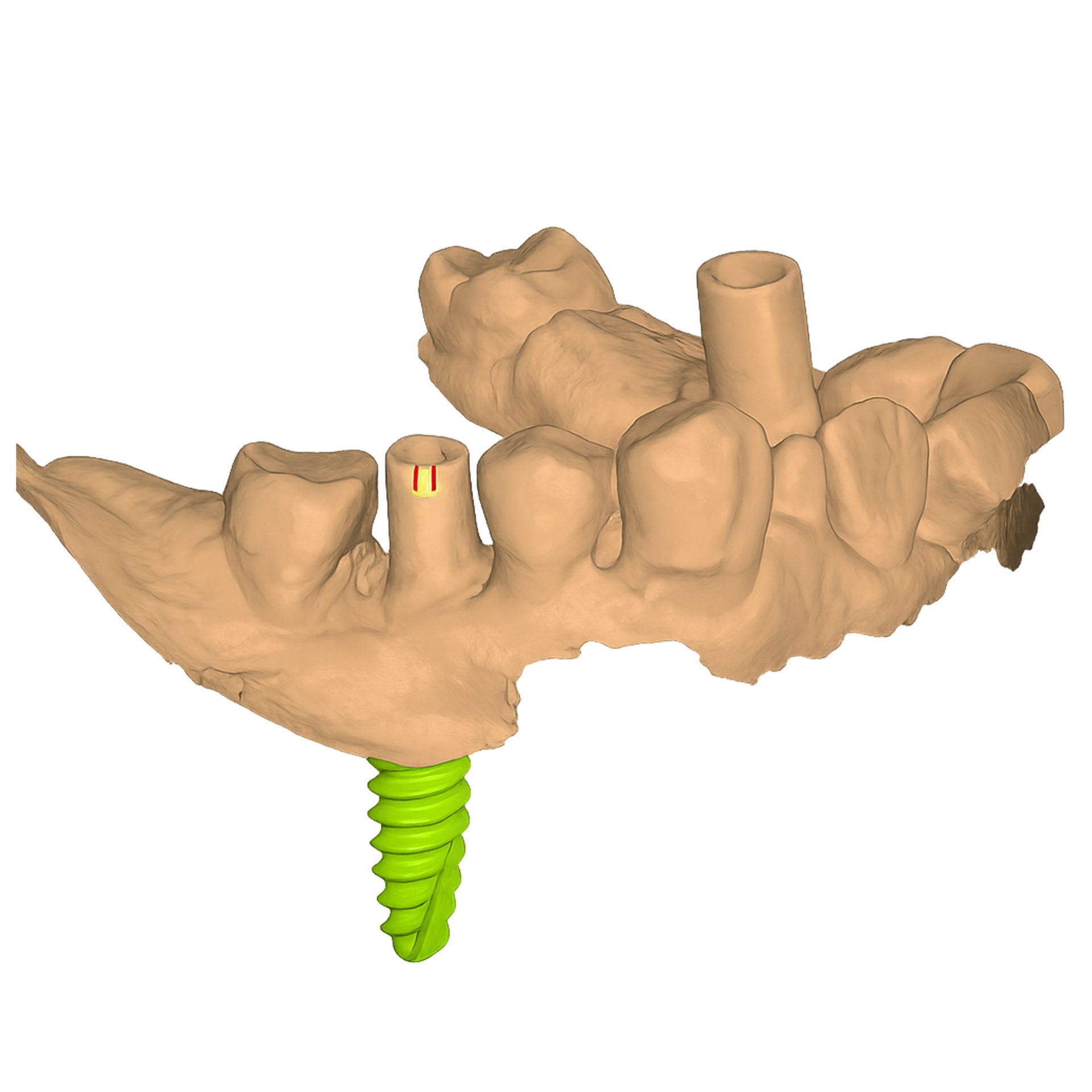Implant surgical guides